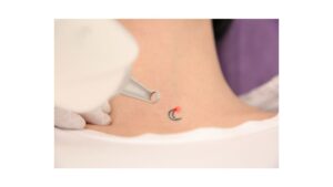 Safe and Effective Tattoo Removal Solutions