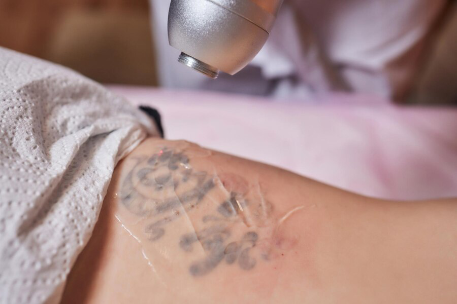 The Evolution of Tattoo Removal
