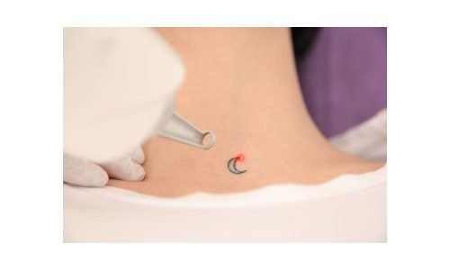 Safe and Effective Tattoo Removal Solutions