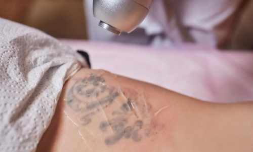 The Evolution of Tattoo Removal
